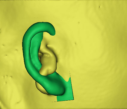 小耳畸形怎么辦？這有一份三維數(shù)字化治療方案請(qǐng)簽收！